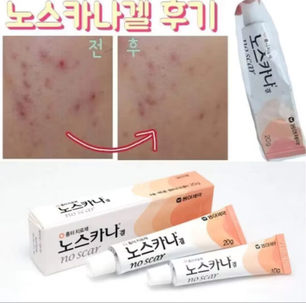 NOSCARNA Scar Gel Treat Keloid, Surgery & Acne Scars 20g - Image 5